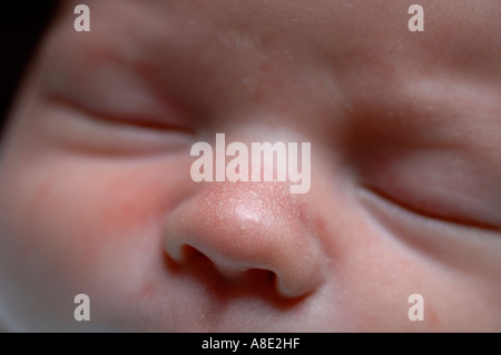 Taches de lait ou milia sur nez de bébé Banque D'Images