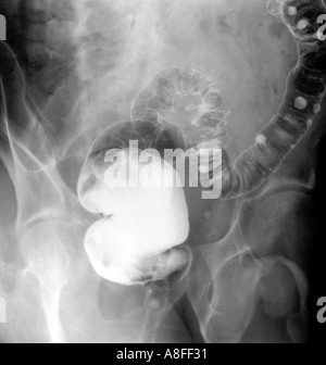 X ray maladie diverticular Banque D'Images