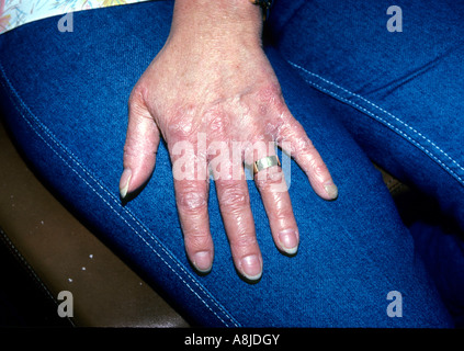 La teigne des mains (tinea manus) en particulier les paumes et les espaces entre les doigts. Banque D'Images