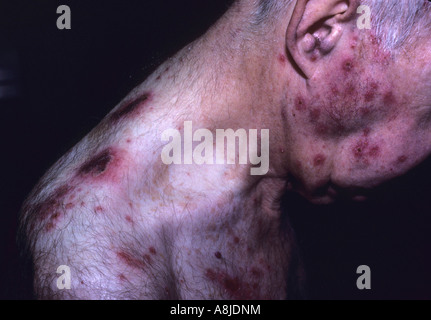 Patient avec l'éruption de la varicelle zona douloureux. Également connu sous le nom de zona Virus de la sharka. Banque D'Images