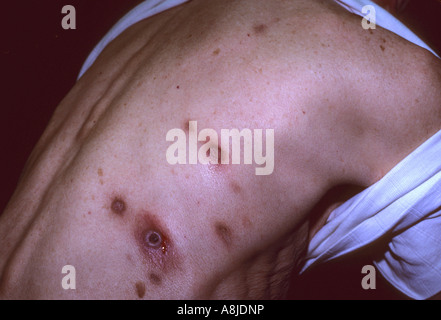 Patient avec l'éruption de la varicelle zona douloureux. Également connu sous le nom de zona Virus de la sharka. Banque D'Images