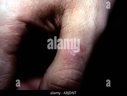 Patient avec l'éruption de la varicelle zona douloureux. Également connu sous le nom de zona Virus de la sharka. Banque D'Images