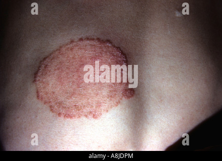 Tinea corporis infection fongique. Banque D'Images