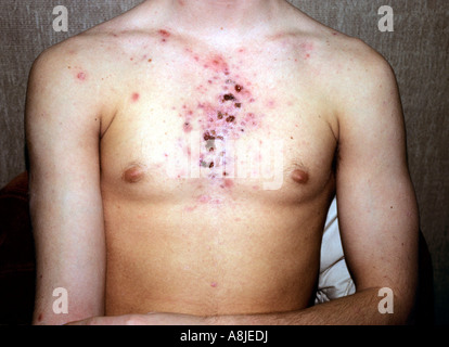 L'acné vulgaire. La dermatologie. Les points noirs sur la poitrine ...