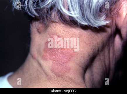 L'allergie aux vêtements. L'éruption sur le cou du patient. Banque D'Images