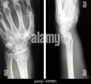 X ray fracture de Pouteau-Colles Banque D'Images