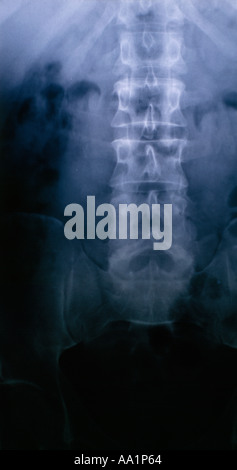 Xray, os, blessures, blessures, Banque D'Images