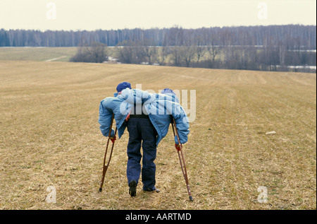 Jumeaux siamois russe masha et dasha krivoshlyapova à Moscou Banque D'Images