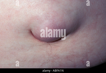 Hernie Ombilicale Photo Stock Alamy