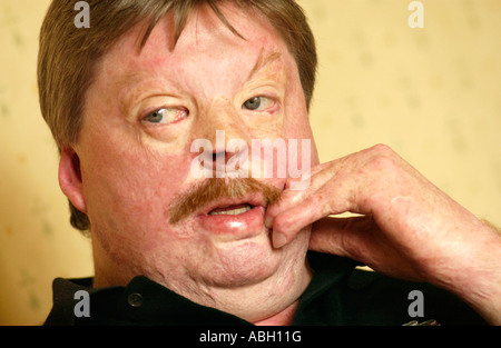 Simon Weston a subi de terribles brûlures lors de demandes Sir Galahad a été bombardée pendant la guerre des Malouines en 1982 avec Welsh Guards Banque D'Images