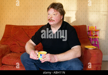 Simon Weston a subi de terribles brûlures lors de demandes Sir Galahad a été bombardée pendant la guerre des Malouines en 1982 avec Welsh Guards Banque D'Images