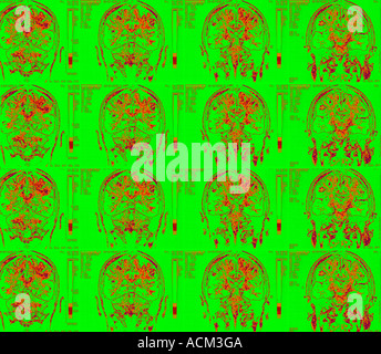 Les rayons colorés de cortex cérébral cervelet IRM du cerveau humain Banque D'Images