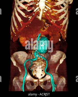 3D CT scan d'un homme de 79 ans avec un anévrisme aortique abdominal mesurant environ 6 cm Banque D'Images