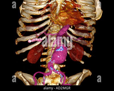 3D CT scan d'un homme de 79 ans avec un anévrisme aortique abdominal mesurant environ 6 cm Banque D'Images