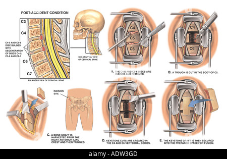 La Chirurgie De La Colonne Vert Brale C Et C Discectomie Cervicale Ant Rieure Avec L