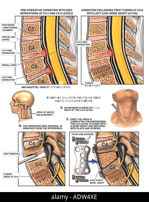 defect oppakken Mauve La chirurgie de la colonne vertébrale - C4-C5 et C5-C6 et du col de  l'Laminotomy Foraminotomy Photo Stock - Alamy