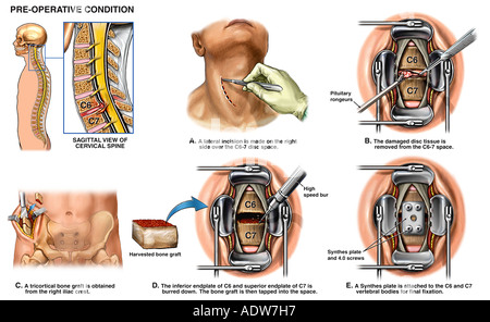 La Chirurgie De La Colonne Vert Brale Disque Cervical En Saillie En C Et C Avec Fusion