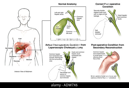 La vésicule biliaire cholécystectomie post-opératoire en cas de fuites