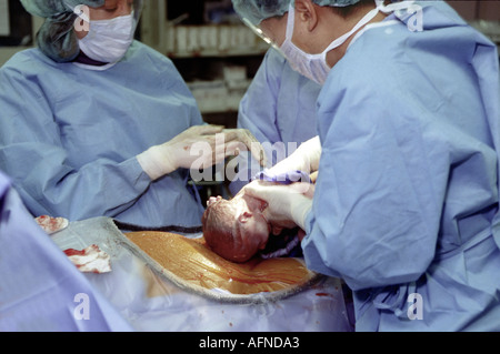 Les médecins dans une salle d'opération effectuer une césarienne sur une femme enceinte Banque D'Images
