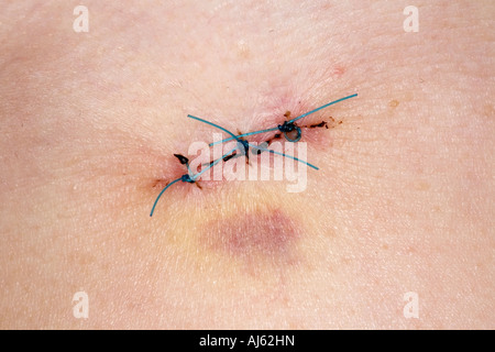 Points de suture dans la peau Banque D'Images