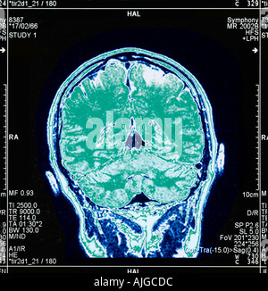 L'imagerie par résonance magnétique (IRM) d'une section à travers une tête humaine, vue arrière montrant le cerveau. Banque D'Images