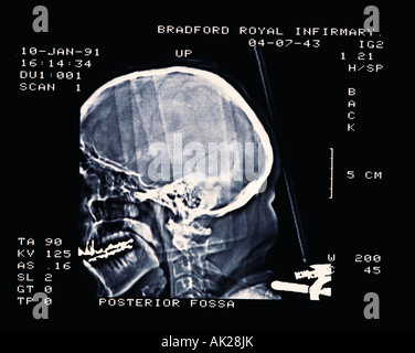 Secteur médical et pharmaceutique, X-Ray de tête humaine, Banque D'Images