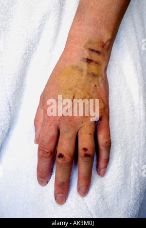 Coupures et ecchymoses sur a woman's hand Banque D'Images