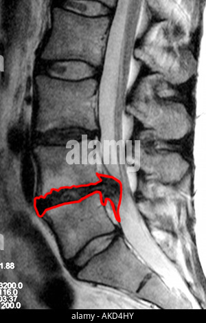 Irm montrant clairement un disque glissé agissant sur la moelle épinière avec la zone touchée entourée en rouge Banque D'Images