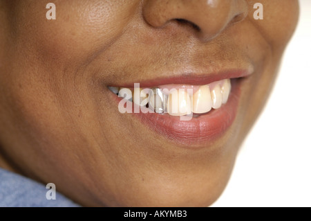 Dents sourire dents dentisterie or or cap sourire placage Banque D'Images