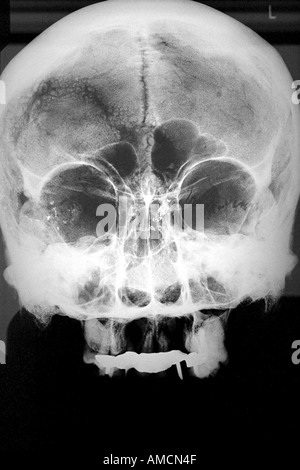 X-ray - suicide (tir) Banque D'Images