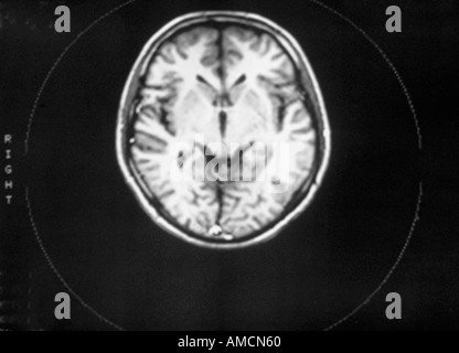 Analyse de l'anatomie normale - RMN Banque D'Images