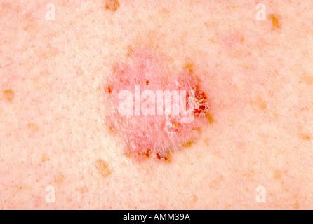 Le carcinome basocellulaire (CBC), ou ulcus rodens, sur un homme de 61