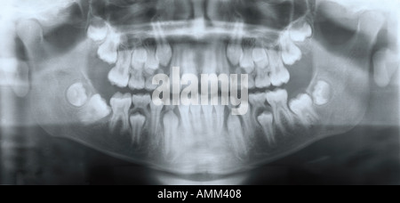 Dental x ray dents incluses Banque D'Images
