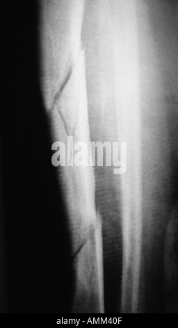 X ray fracture comminutive du tibia Banque D'Images