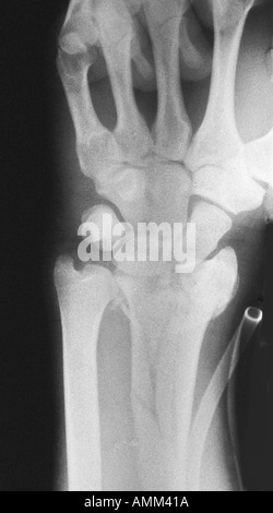AP x ray broyé, fracture du radius distal Banque D'Images