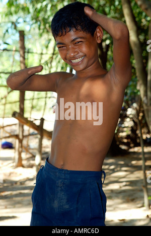 Mine victime âgée de 12 ans n'a pas de mains rehabilitation centre à Siem Reap au Cambodge Banque D'Images