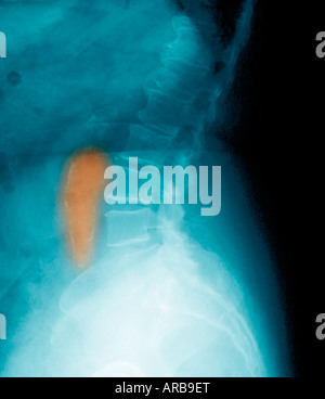 Anévrisme aortique asymptomatique vu sur x-ray abdominale latérale d'une jeune femme de 80 ans Banque D'Images