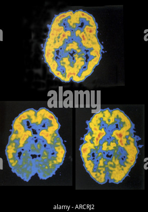 Une image montrant trois la tomographie par émission de positons (TEP). Banque D'Images