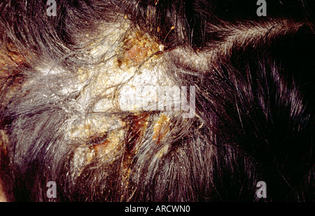 Tinea capitis (la teigne du cuir chevelu) est causée par une infection fongique. Banque D'Images