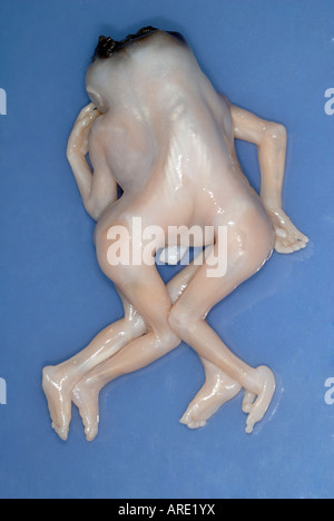 Jumeaux siamois Dipygus Banque D'Images