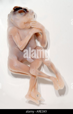 Jumeaux siamois Dipygus Banque D'Images