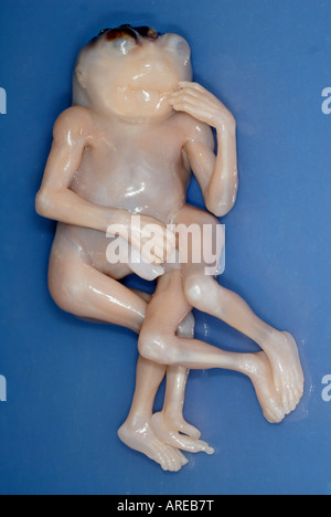 Jumeaux siamois Dipygus Banque D'Images