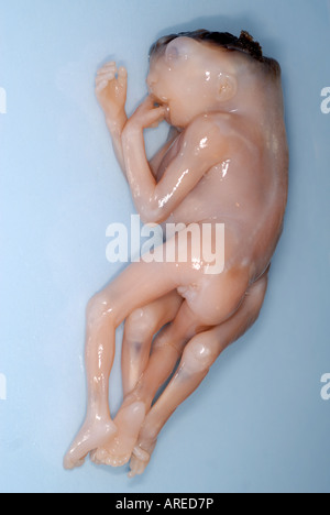 Jumeaux siamois Dipygus Banque D'Images