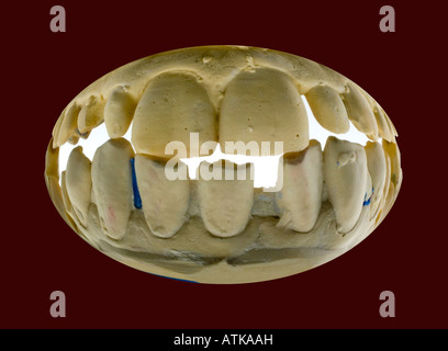 Modell für Zahnersatz prothèses dentaires Banque D'Images