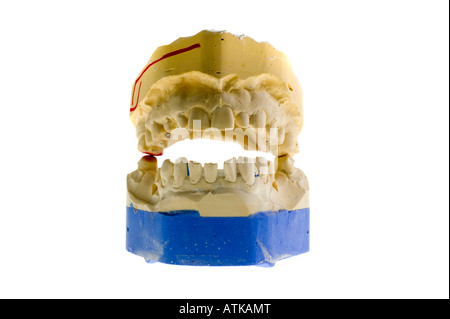 Modell für Zahnersatz prothèses dentaires Banque D'Images