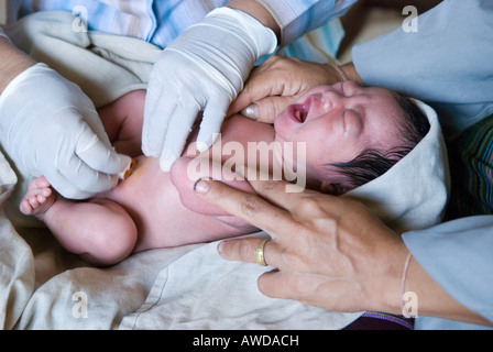 Medic nettoyer un cordon ombilical du nouveau-né, Kou Kou Kou Kou clinique, Swe, village-IDP Région en bordure de la Thaïlande près de Maesot, Bir Banque D'Images