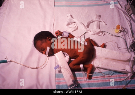 Le faible poids à la naissance bébé né d'une femme qui avait l'habitude du crack au cours de sa grossesse Banque D'Images