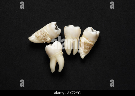 Les dents extraites sur fond sombre Banque D'Images