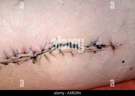 Close up de suture sur la cuisse intérieure gauche de l'opération pour supprimer un grade élevé sur les sarcomes des tissus mous Banque D'Images