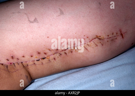 Cicatrice sur l'intérieur de la cuisse gauche de l'opération pour supprimer un grade élevé sur les sarcomes des tissus mous Banque D'Images
